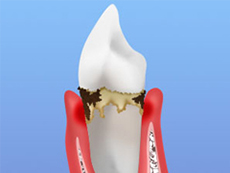 中期歯周炎